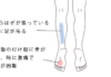 鍼･活法整体で改善したモートン病･足底腱膜炎の症例(治療例)