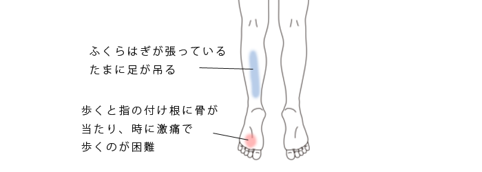 鍼･活法整体で改善したモートン病･足底腱膜炎の症例(治療例)
