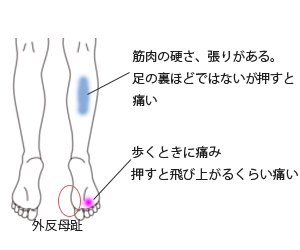 鍼治療･活法整体で改善した足の裏の痛み