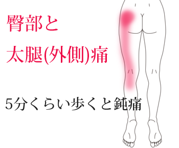 鍼治療による臀部下肢痛の改善例