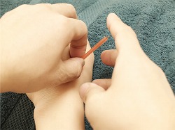 手のツボに鍼を打つ