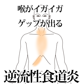 埼玉県志木市のいろは治療院による逆流性食道炎の改善例